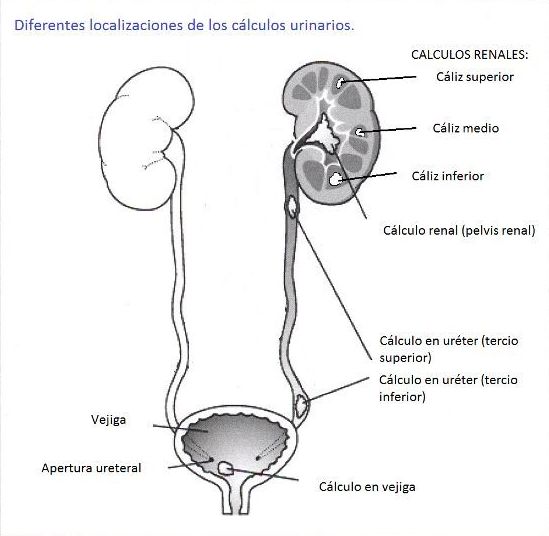 piedras en el riñon