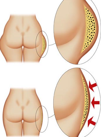 lipoescultura